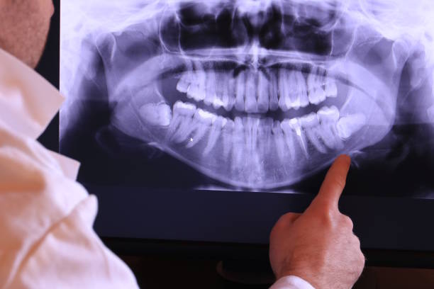 Best Emergency Tooth Extraction in Astatula, FL