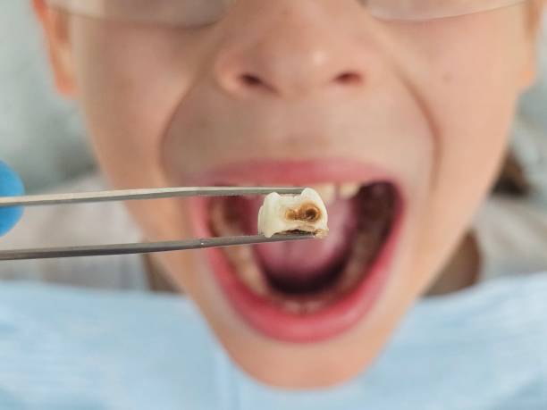 Best Emergency Tooth Extraction in Astatula, FL
