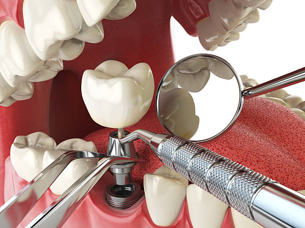 Best Emergency Tooth Extraction in Astatula, FL